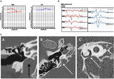 Audiovestibular Quantification in Rare Third Window Disorders in Children